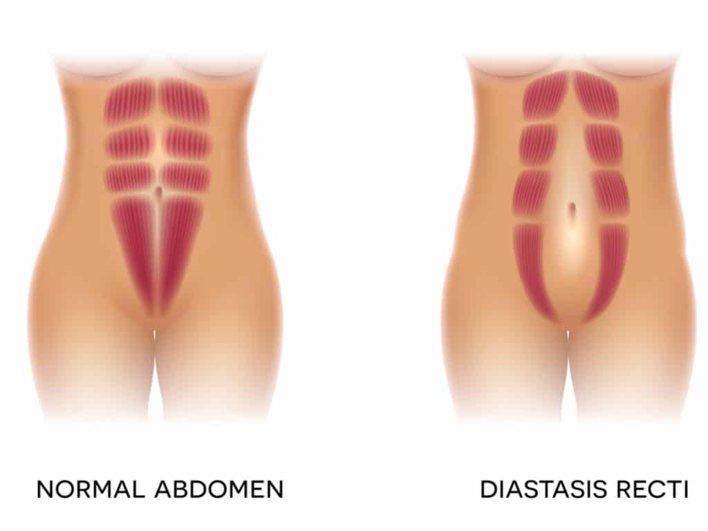Replying to @Mary How do you know if you have diastasis recti or a her