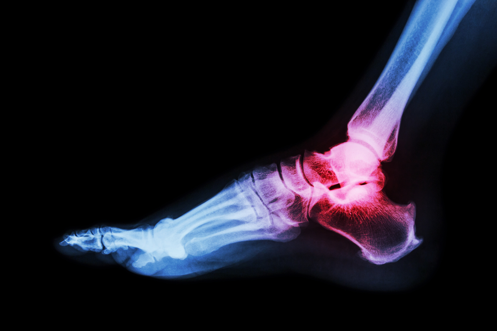 x-ray showing ankle arthritis requiring treatment in Knoxville