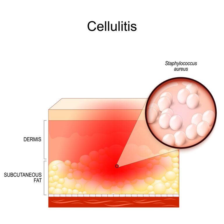 Illustration depicting details of cellulitis