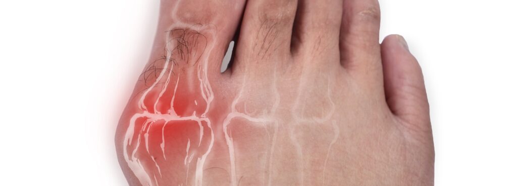 picture of a foot requiring bunion treatment in Knoxville